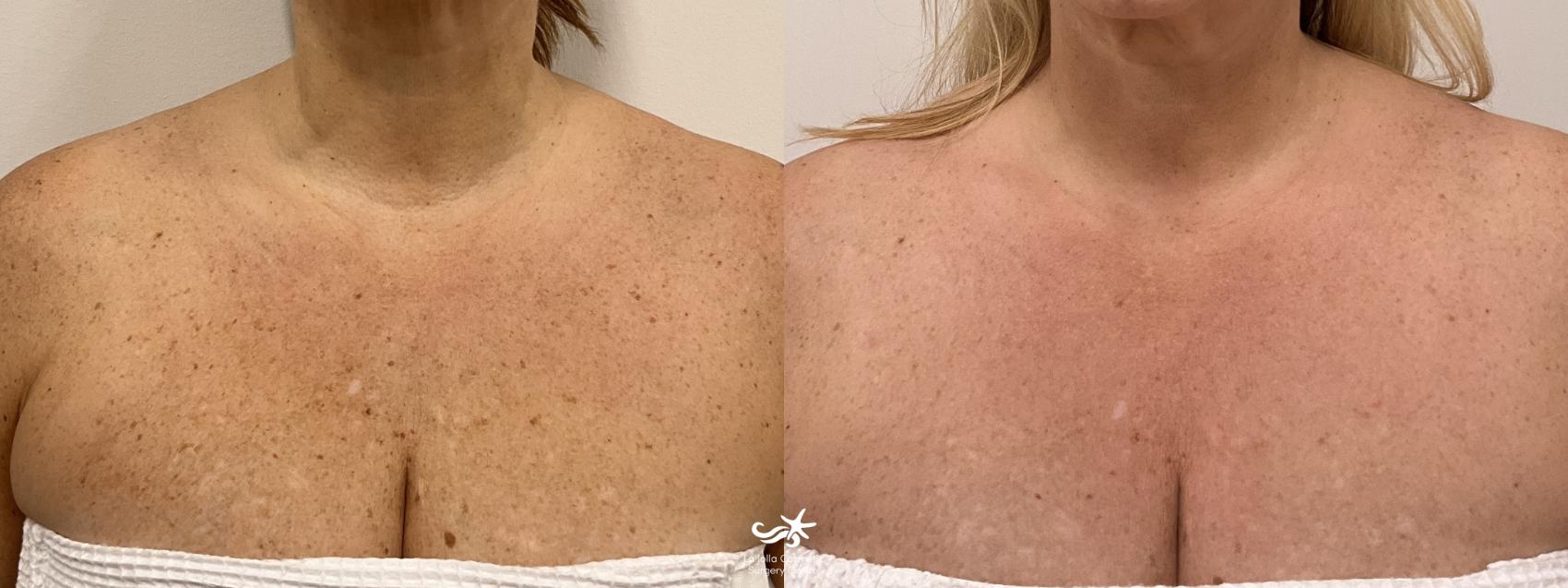 Before & After Laser Treatments Result 859 Front View in San Diego, Carlsbad, CA