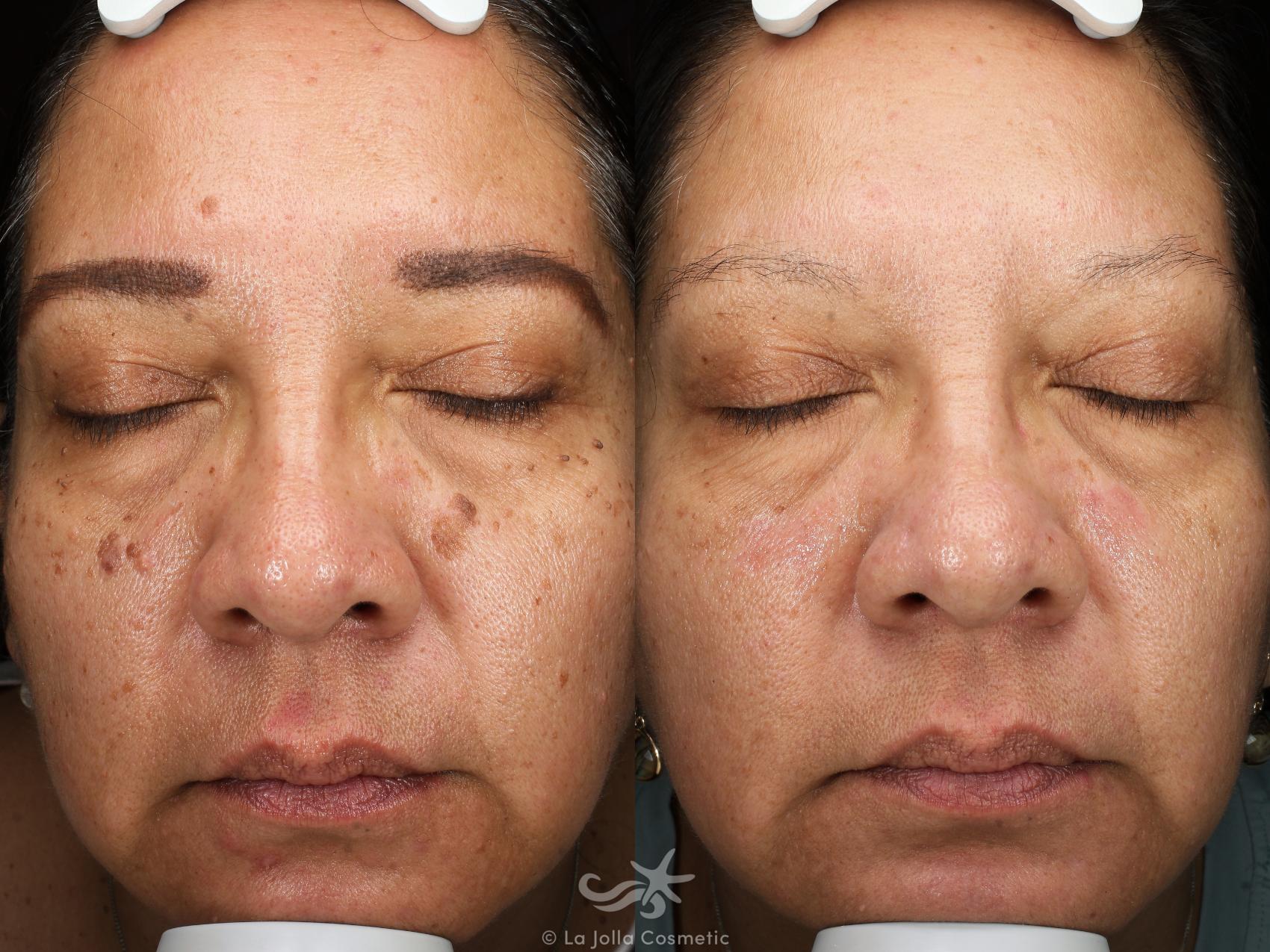 Before & After Laser Treatments Result 900 Front View in San Diego, Carlsbad, CA
