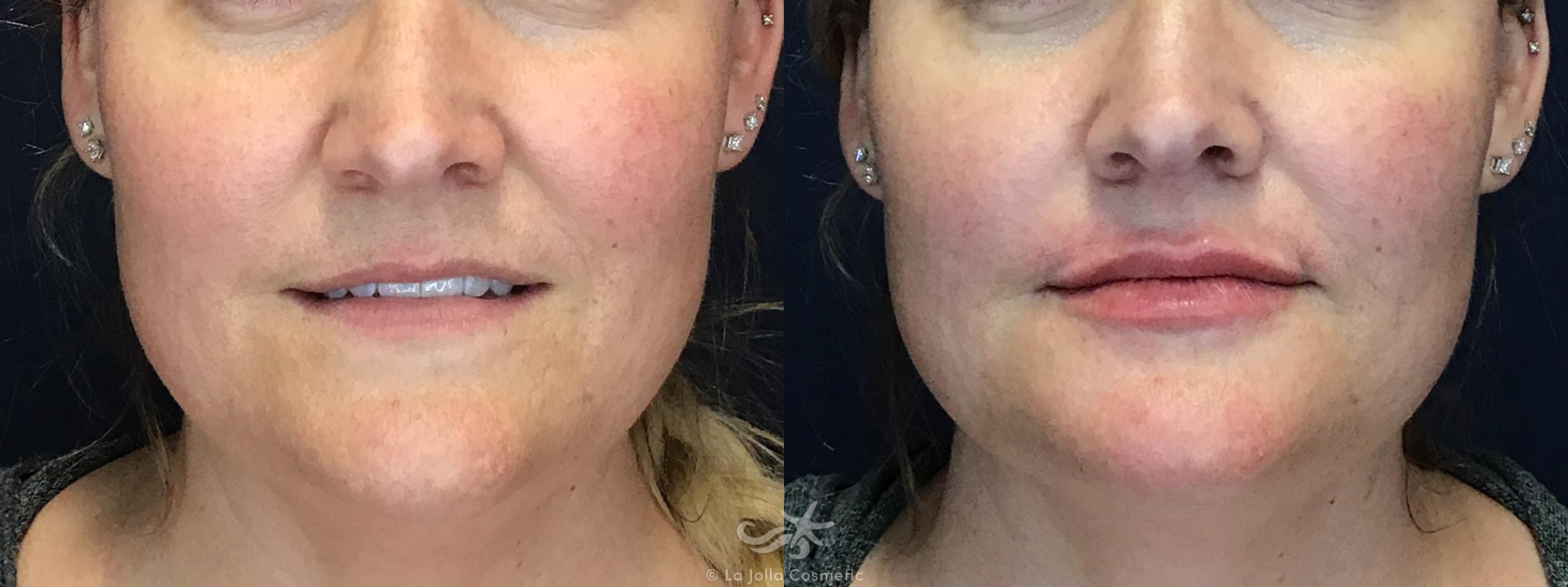 Before & After Lip Fillers Result 111 Front View in San Diego, CA