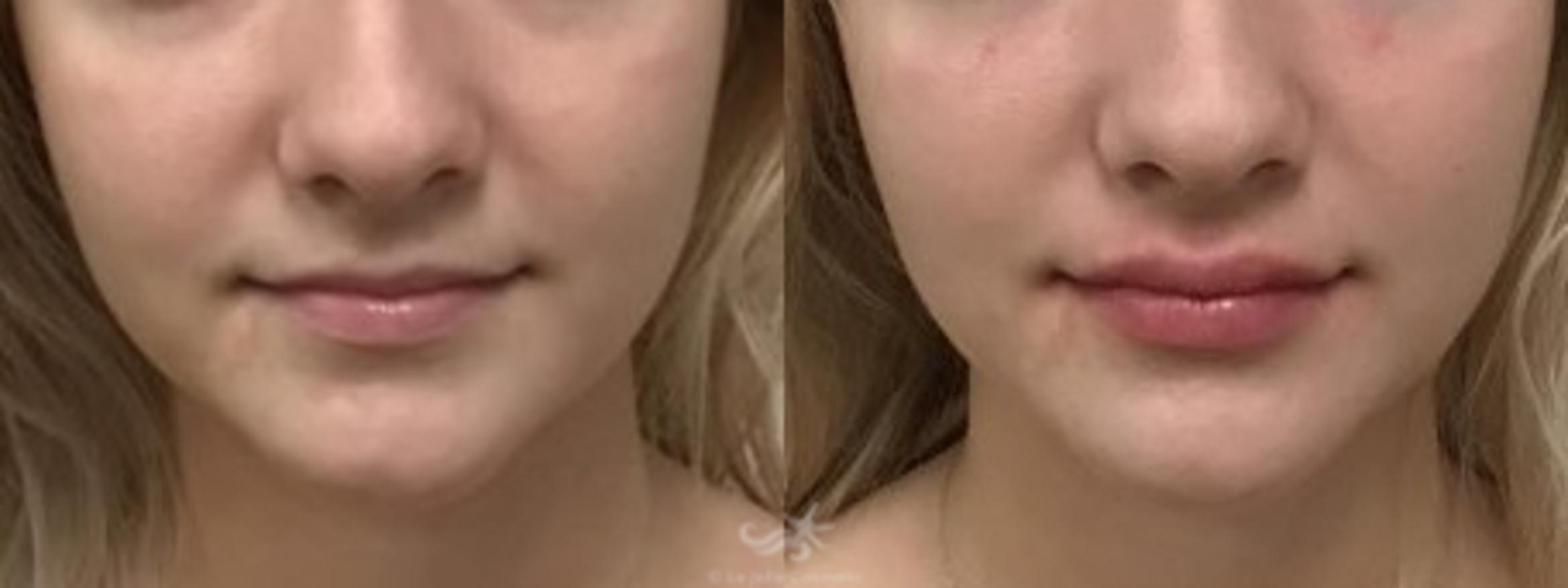 Before & After Lip Enhancement Result 119 Front View in San Diego, CA
