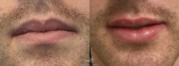 Before & After Lip Enhancement Result 54 Front View in San Diego, Carlsbad, CA