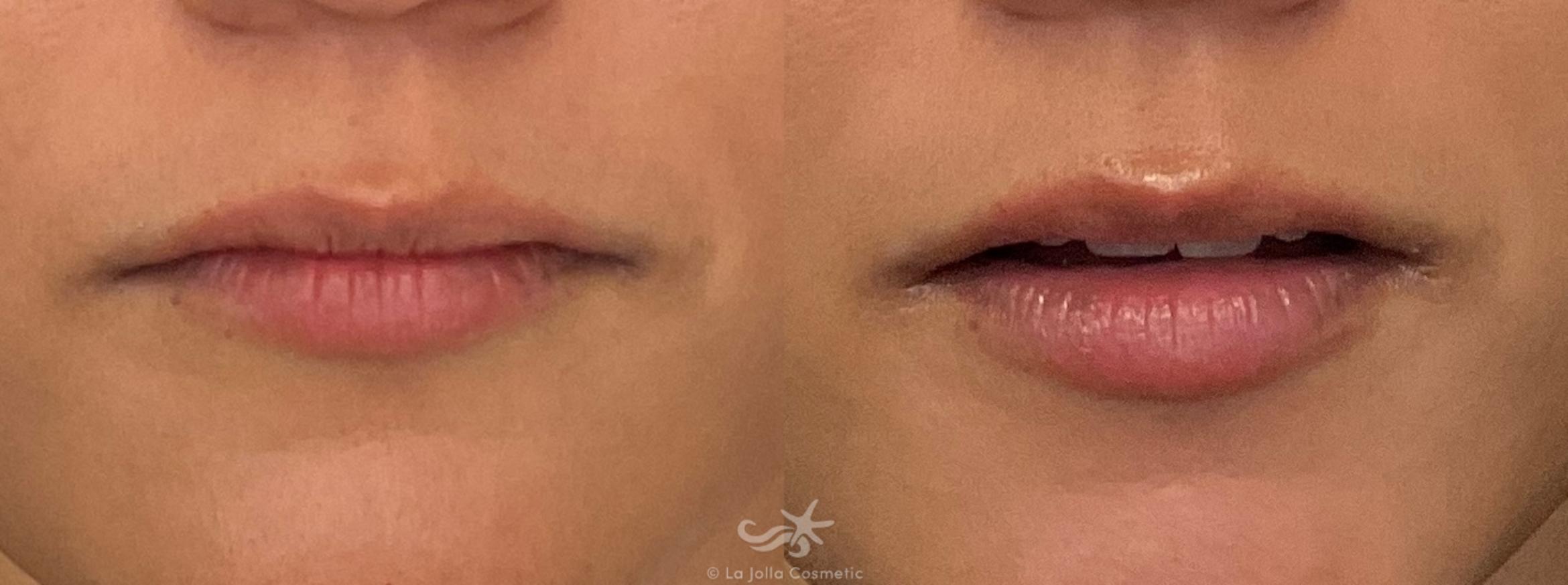 Before & After Lip Fillers Result 654 Front View in San Diego, CA