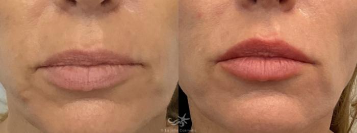 Before & After Lip Enhancement Result 656 Front View in San Diego, Carlsbad, CA