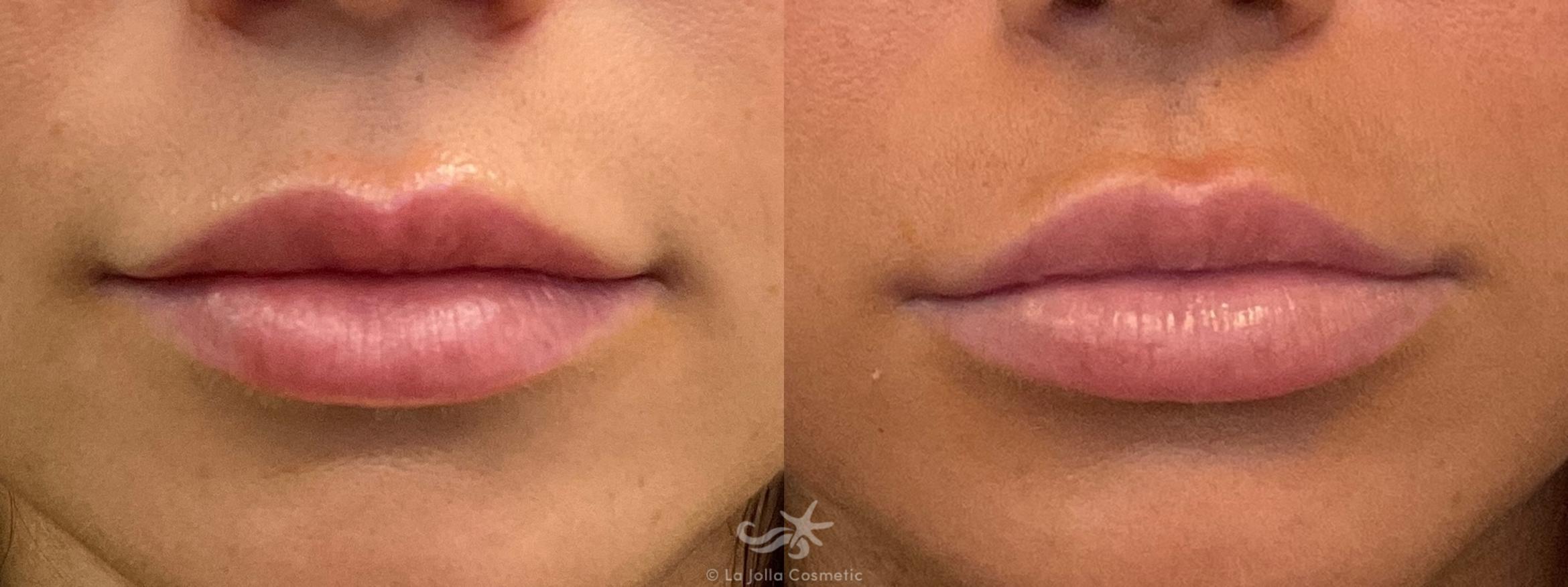 Before & After Lip Fillers Result 661 Front View in San Diego, CA