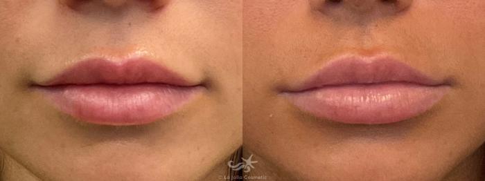 Before & After Lip Enhancement Result 661 Front View in San Diego, Carlsbad, CA