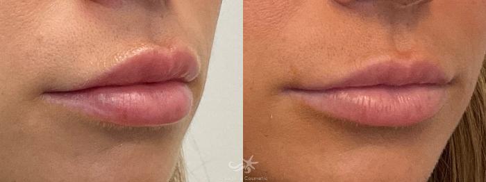 Before & After Lip Enhancement Result 661 Right Oblique View in San Diego, Carlsbad, CA