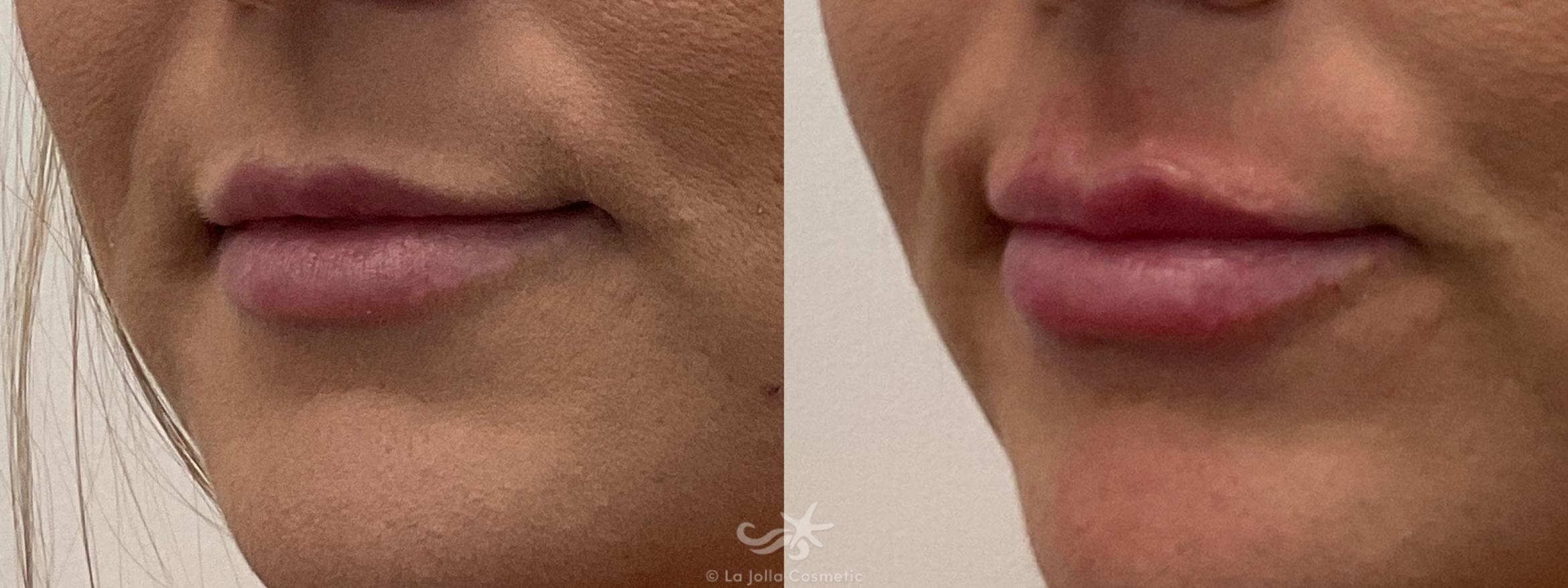 Before & After Lip Fillers Result 663 Left Oblique View in San Diego, CA