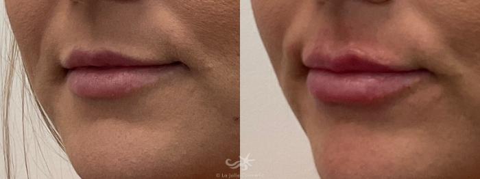 Before & After Lip Enhancement Result 663 Left Oblique View in San Diego, Carlsbad, CA