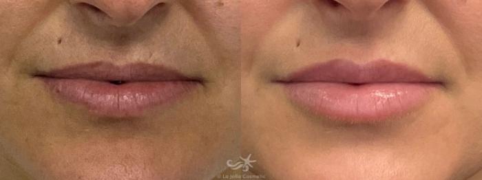 Before & After Lip Enhancement Result 695 Front View in San Diego, Carlsbad, CA