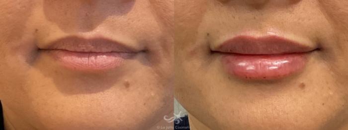 Before & After Lip Enhancement Result 748 Front View in San Diego, Carlsbad, CA