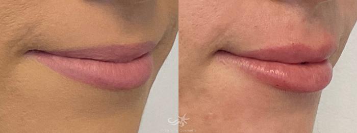 Before & After Lip Enhancement Result 758 Right Oblique View in San Diego, Carlsbad, CA