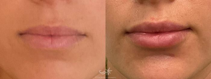 Before & After Lip Enhancement Result 759 Front View in San Diego, Carlsbad, CA