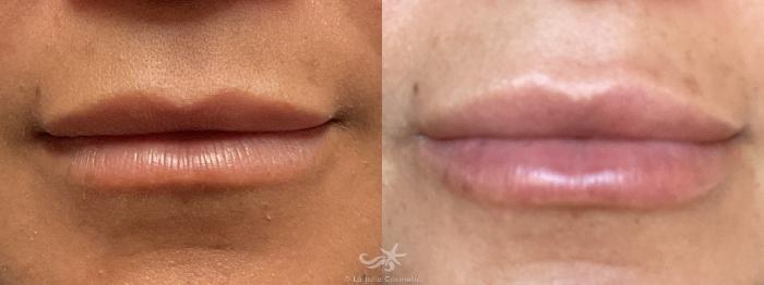 Before & After Lip Enhancement Result 760 Front View in San Diego, Carlsbad, CA