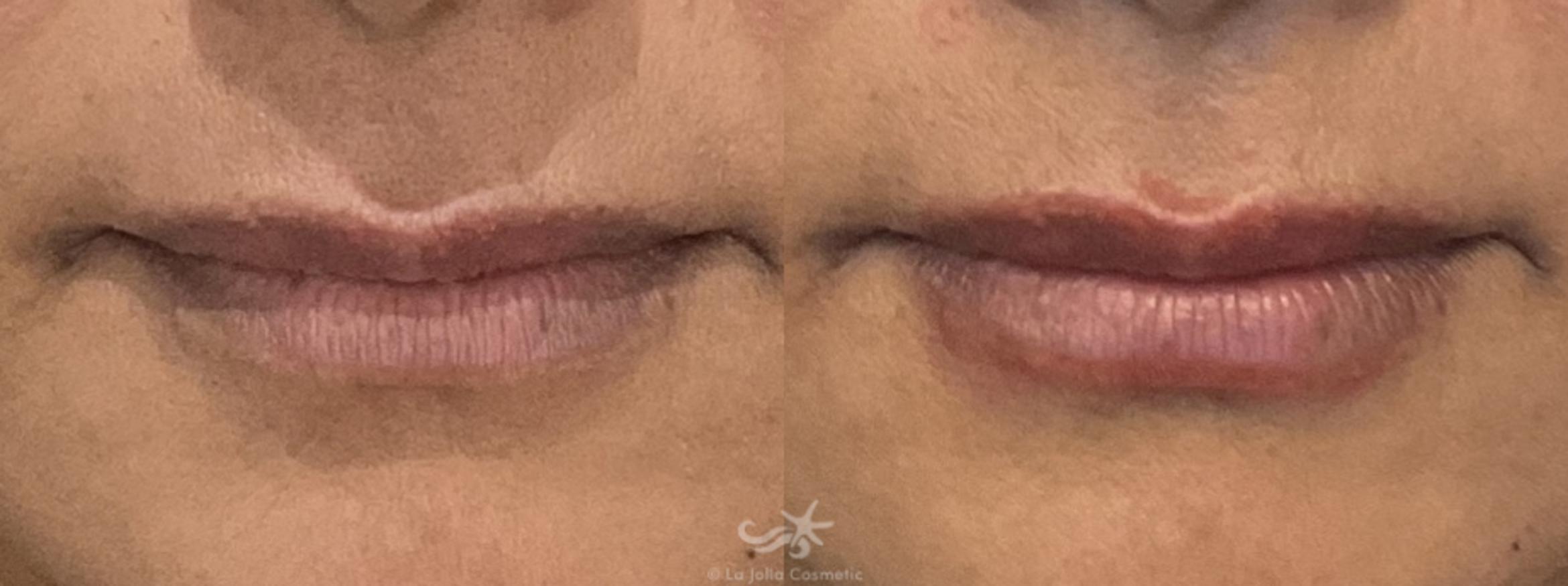 Before & After Lip Enhancement Result 761 Front View in San Diego, Carlsbad, CA