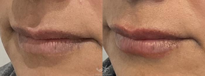 Before & After Lip Enhancement Result 761 Left Oblique View in San Diego, Carlsbad, CA