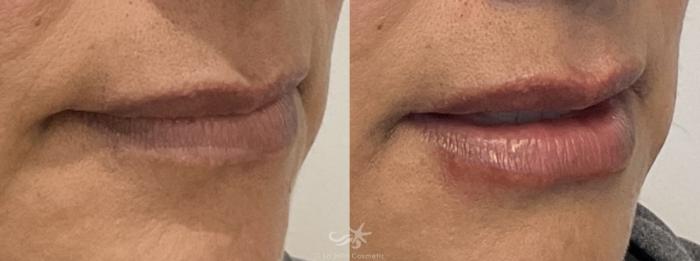 Before & After Lip Enhancement Result 761 Right Oblique View in San Diego, Carlsbad, CA
