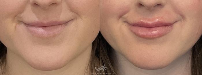 Before & After Lip Enhancement Result 763 Front Smile View in San Diego, Carlsbad, CA