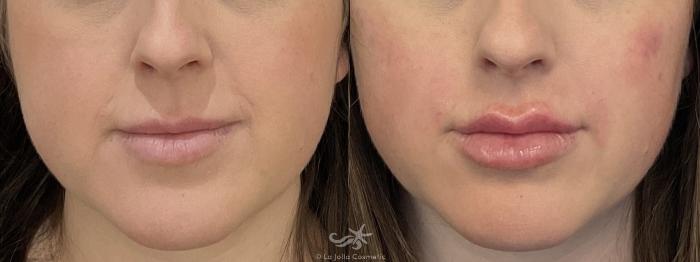 Before & After Lip Enhancement Result 763 Front View in San Diego, Carlsbad, CA