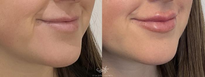 Before & After Lip Enhancement Result 763 Right Oblique View in San Diego, Carlsbad, CA