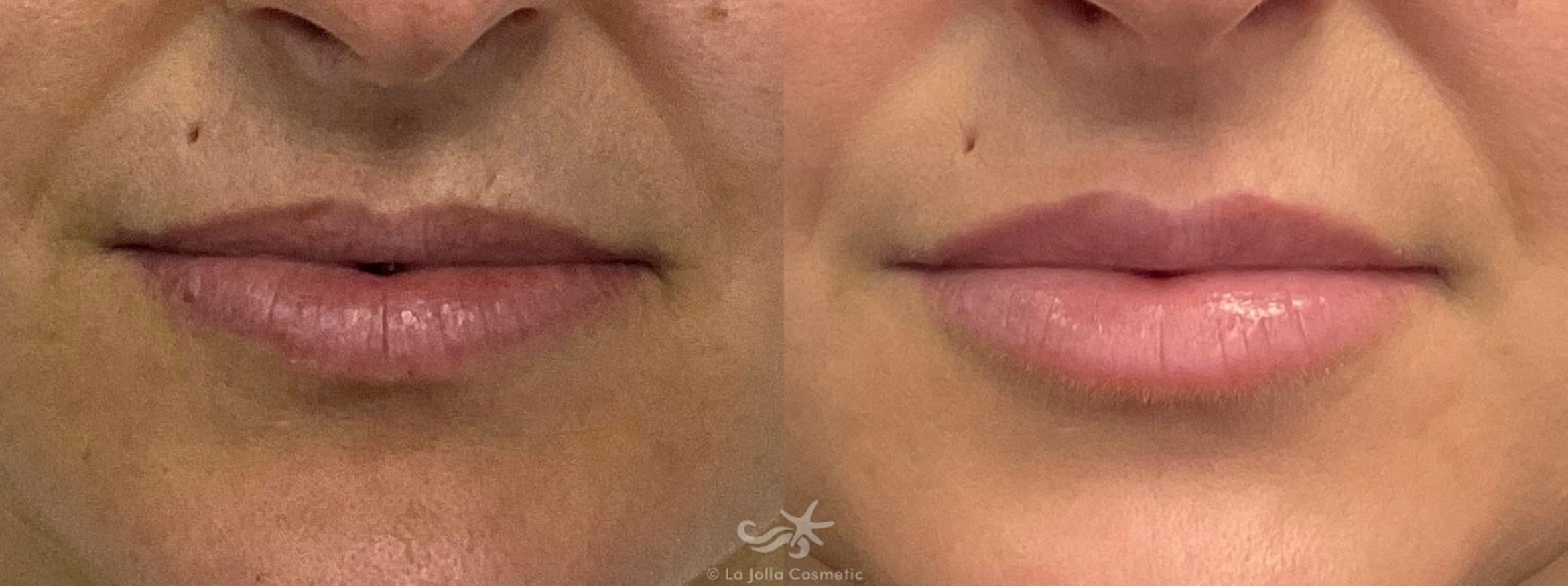 Before & After Lip Fillers Result 695 Front View in San Diego, CA