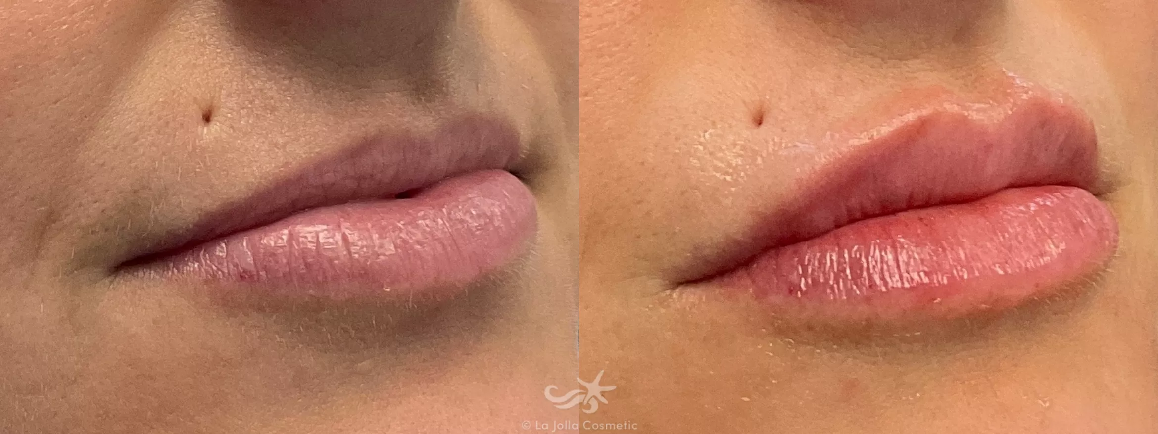 Before & After Lip Enhancement Result 695 Right Oblique View in San Diego, CA