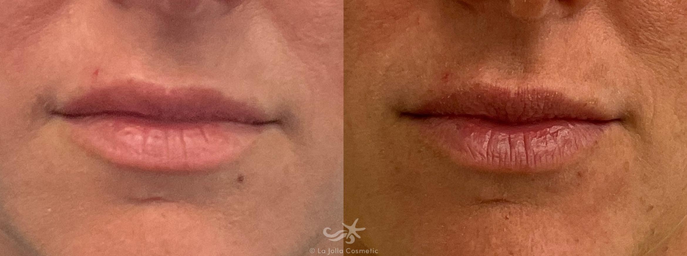 Before & After Lip Fillers Result 717 Front View in San Diego, CA