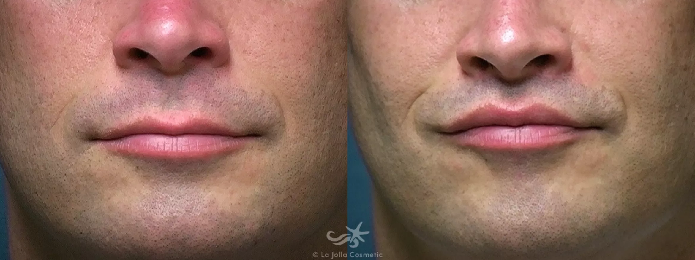 Before & After Lip Lift Result 371 Front View in San Diego, CA