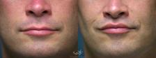 Before & After Lip Lift Result 371 Front View in San Diego, Carlsbad, CA