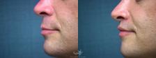 Before & After Lip Lift Result 371 Left Side View in San Diego, Carlsbad, CA