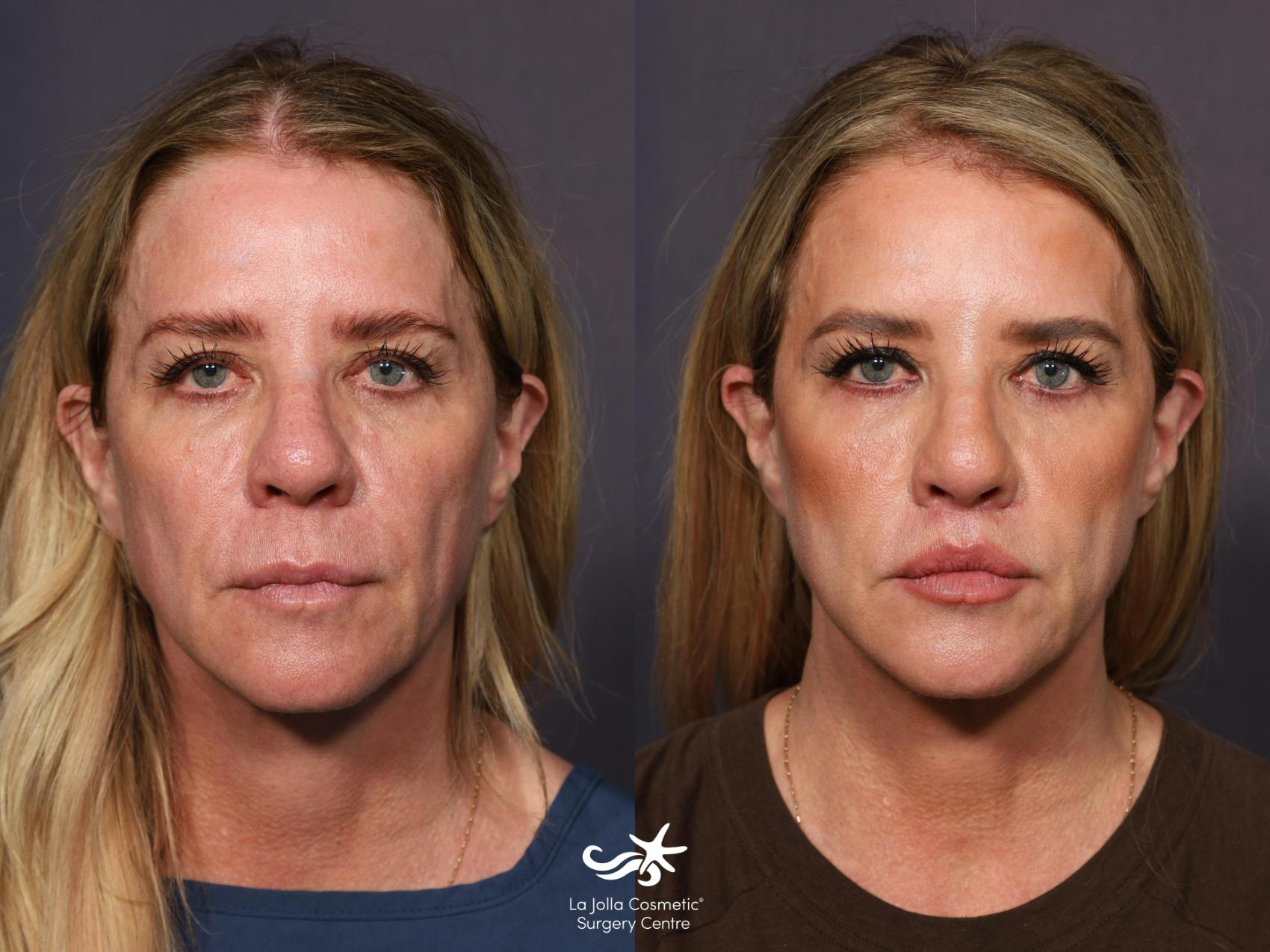 Before & After Lip Lift Result 871 Front View in San Diego, CA