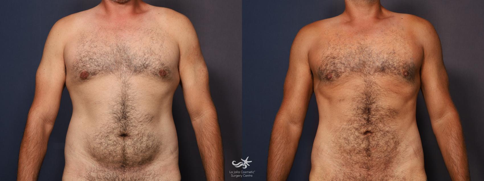 Liposuction Before and After Pictures Result 1028 San Diego