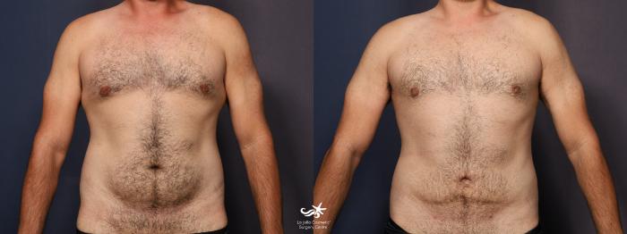 Liposuction - Male Chest Before and After Pictures Case 3, Coeur d'Alene,  ID