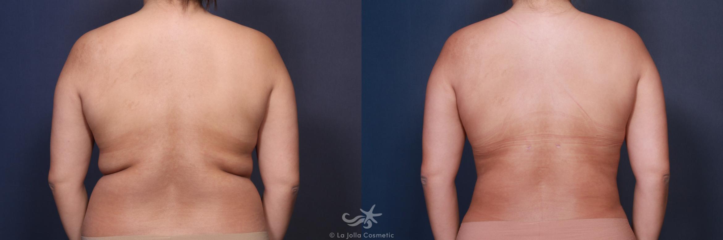 Before & After Liposuction Result 106 Back View in San Diego, CA