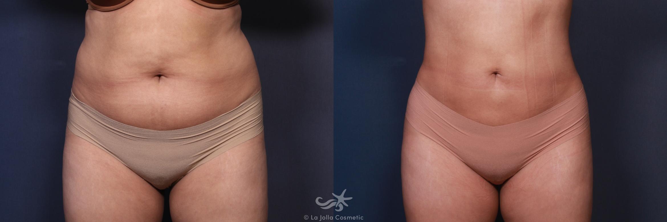 Before & After Liposuction Result 106 Front View in San Diego, CA