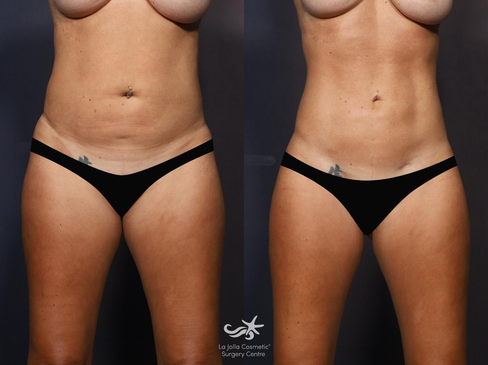 Before & After Liposuction Result 1262 Front View in San Diego, CA
