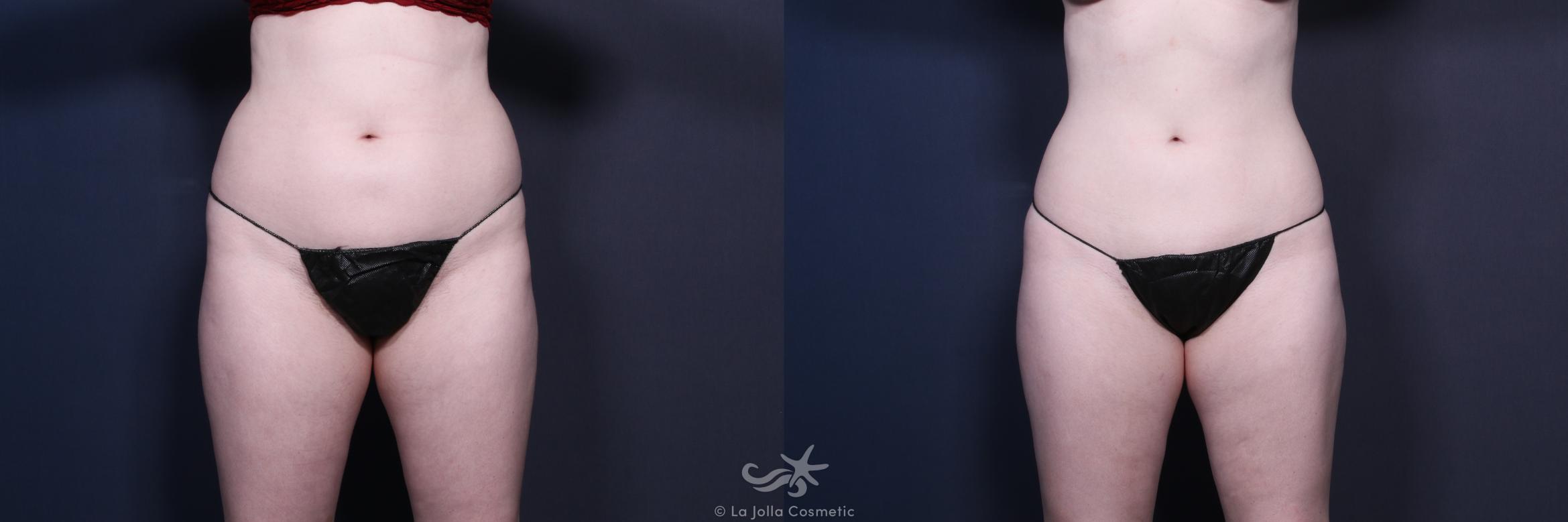 Before & After Liposuction Result 133 Front View in San Diego, CA