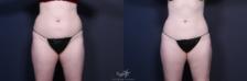 Before & After Liposuction Result 133 Front View in San Diego, Carlsbad, CA