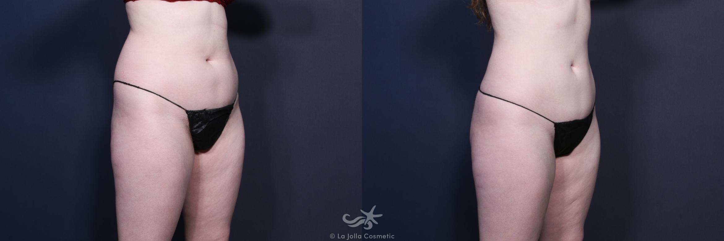 Before & After Liposuction Result 133 Right Oblique View in San Diego, CA