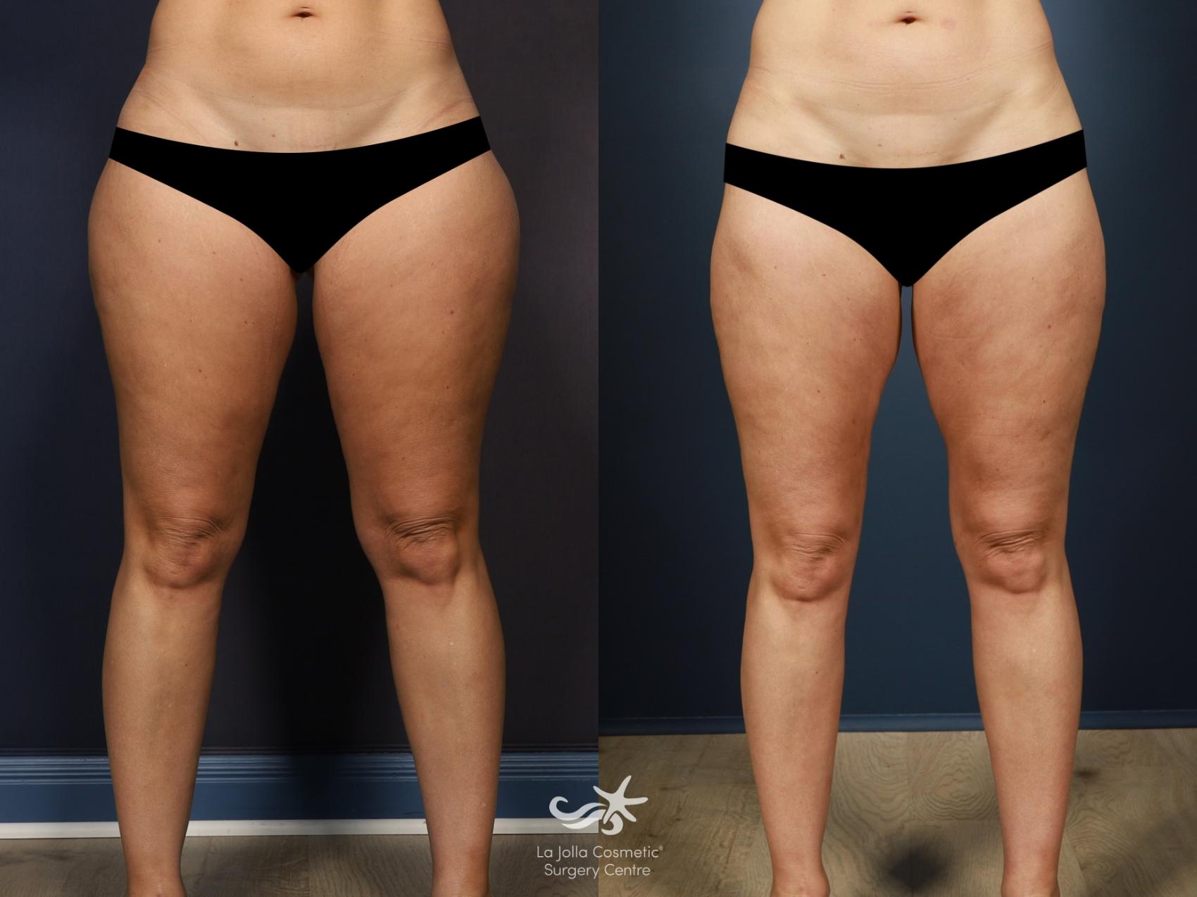 Before & After Liposuction Result 1349 Front View in San Diego, CA