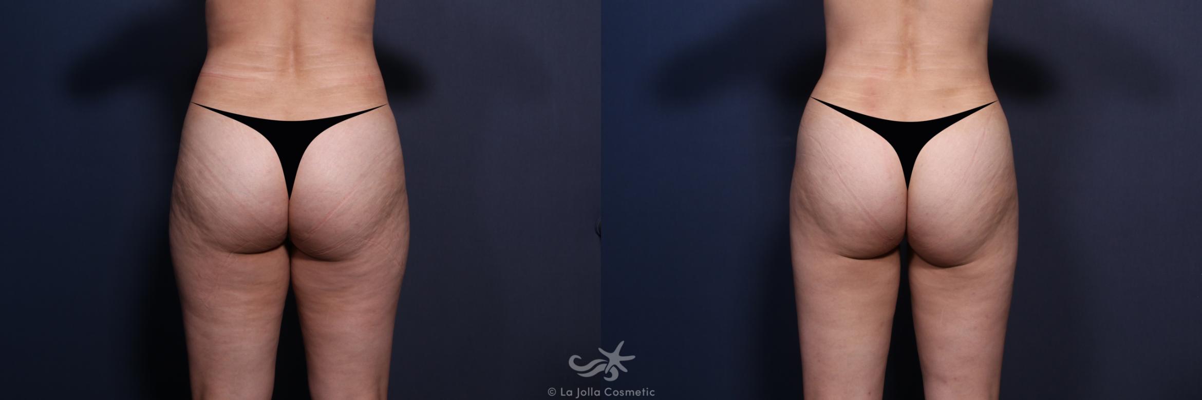 Before & After Liposuction Result 155 Back View in San Diego, CA
