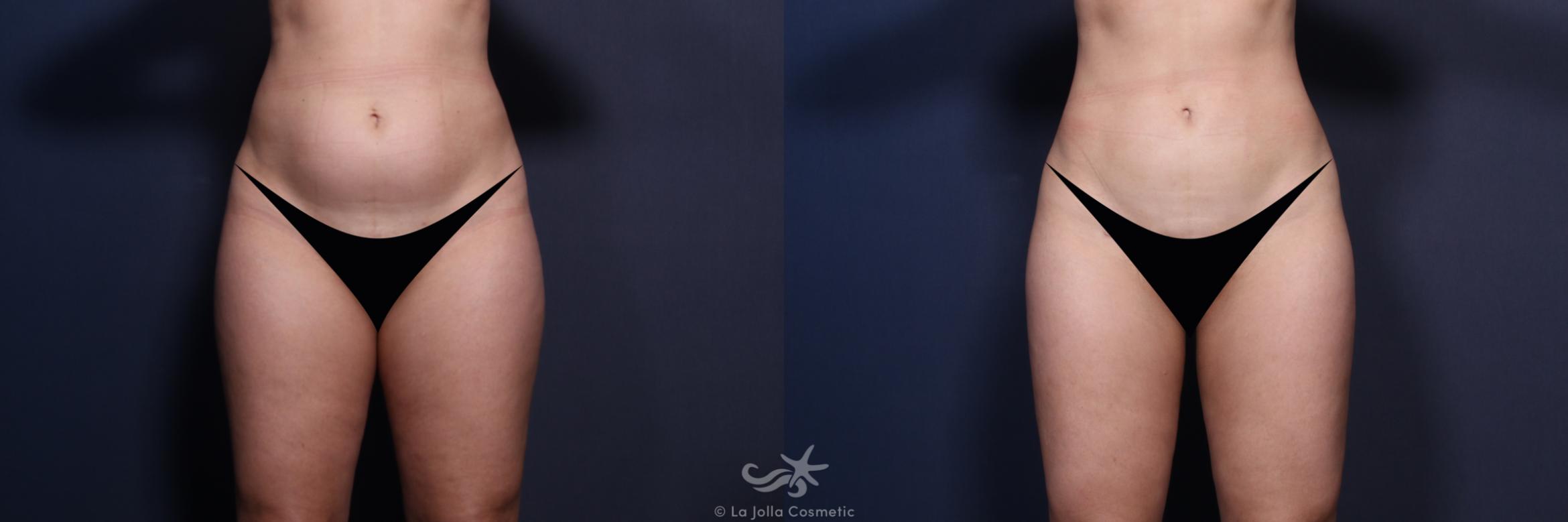 Before & After Liposuction Result 155 Front View in San Diego, CA
