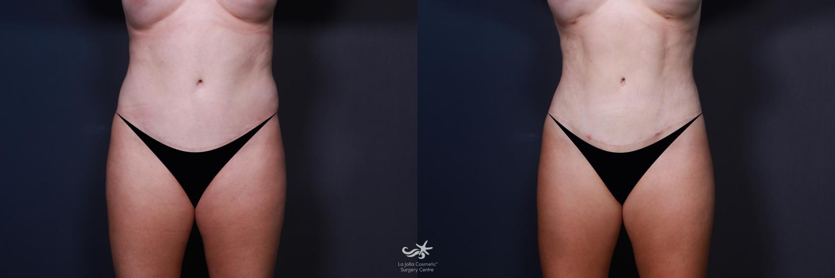 Before & After Liposuction Result 190 Front View in San Diego, CA