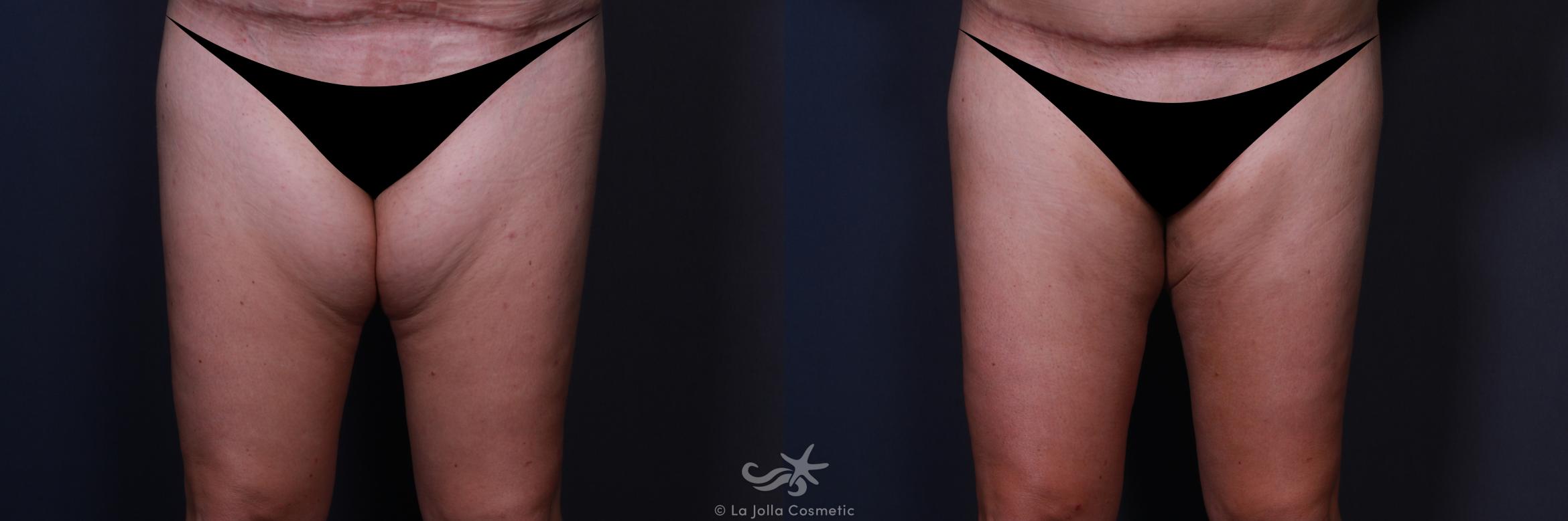 Before & After Liposuction Result 191 Front View in San Diego, CA