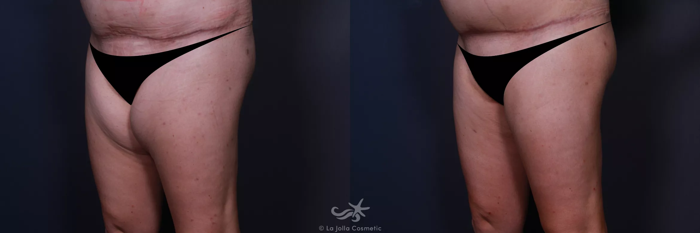 Before & After Liposuction Result 191 Left Oblique View in San Diego, CA