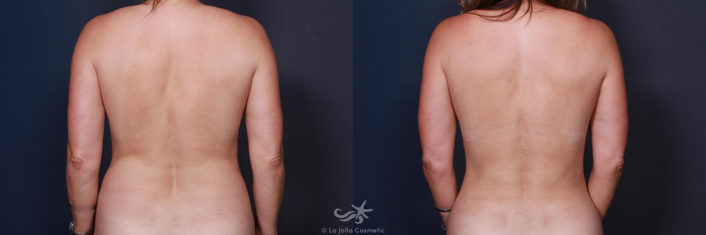 Before & After Liposuction Result 216 Back View in San Diego, CA