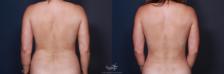 Before & After Liposuction Result 216 Back View in San Diego, Carlsbad, CA