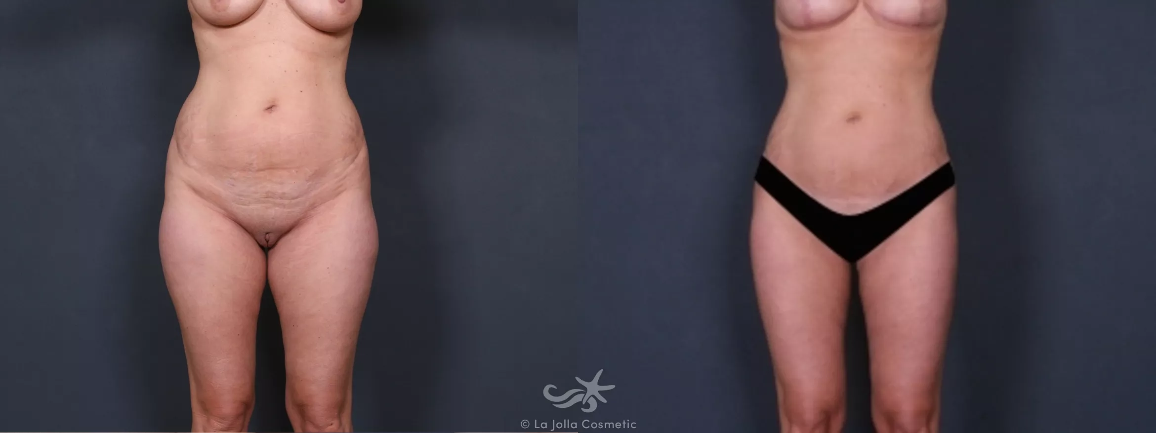 Before & After Liposuction Result 264 Front View in San Diego, CA