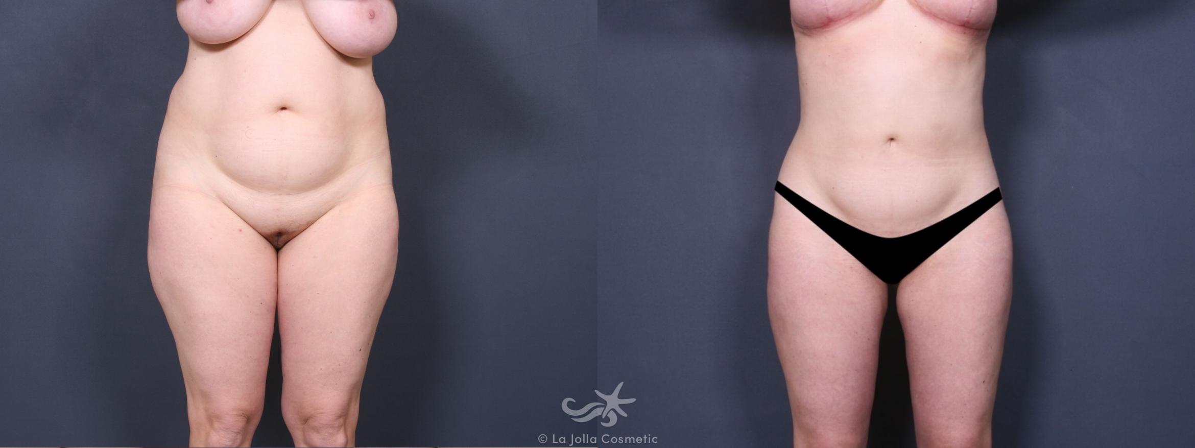 Before & After Liposuction Result 268 Front View in San Diego, CA