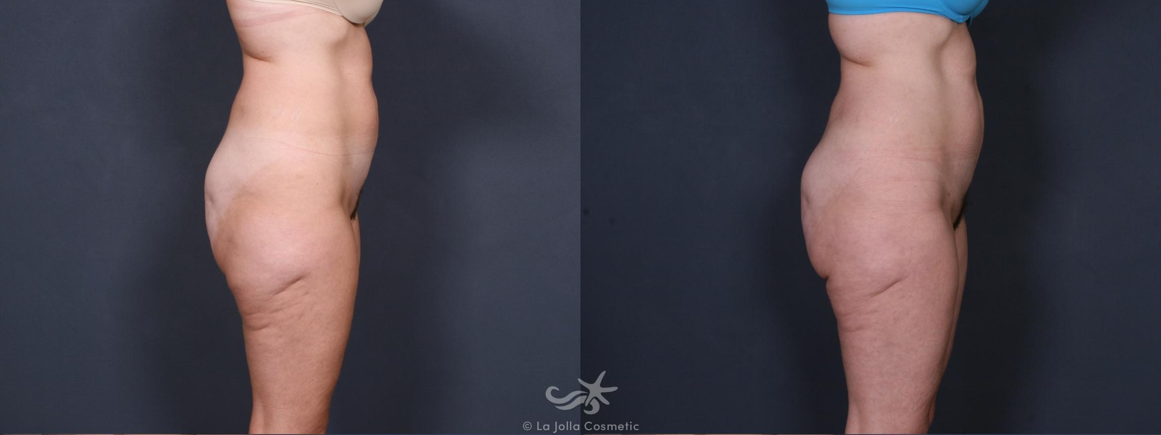Before & After Liposuction Result 304 Right Side View in San Diego, CA
