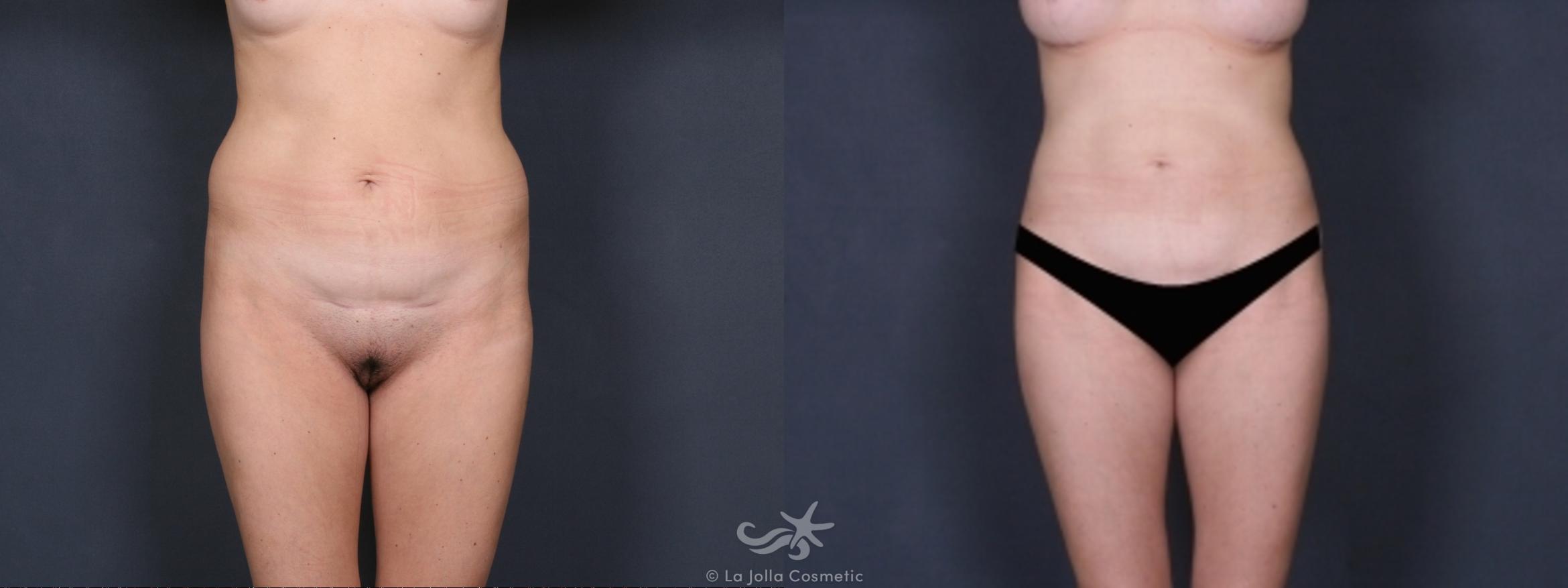 Before & After Liposuction Result 315 Front View in San Diego, CA